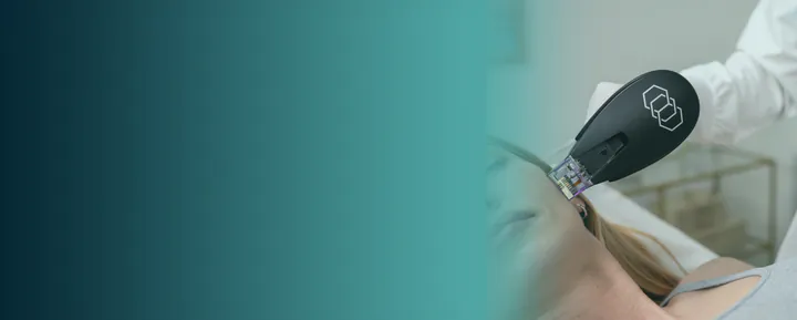 Morpheus8 RF microneedling handpiece on the cheek, available at Square Mile Clinic, City of London